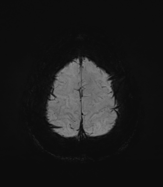 Normal MRI internal auditory canal (Radiopaedia 41613-44525 Axial SWI MIP 72).png