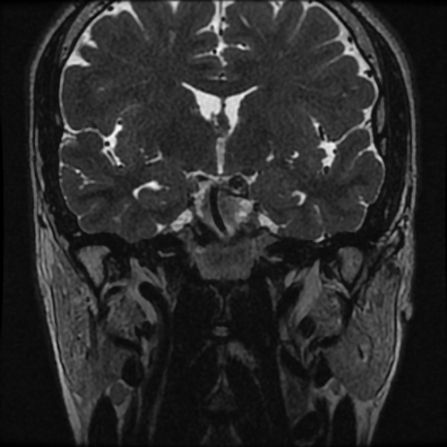 Normal MRI petrous (Radiopaedia 91317-108949 Coronal T2 19).jpg
