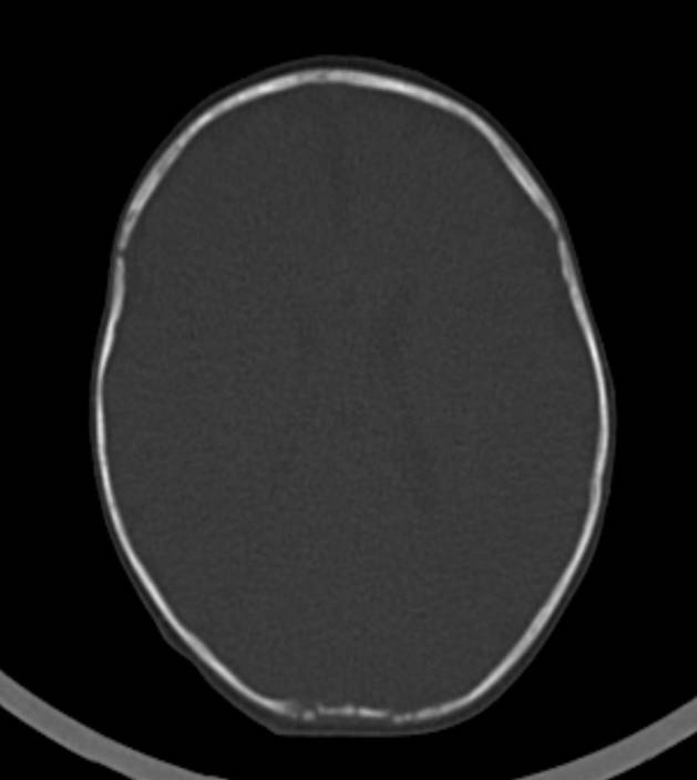 Normal brain CT - 2-month-old (Radiopaedia 53369-59350 Axial bone window 24).jpg