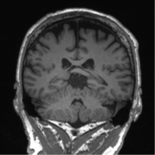 Normal brain MRI (non-focal epilepsy protocol) (Radiopaedia 53917-60040 Coronal T1 27).png