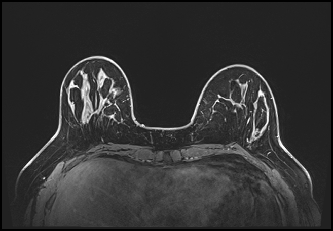 Normal breast MRI - dense breasts (Radiopaedia 80454-93850 C 65).jpg