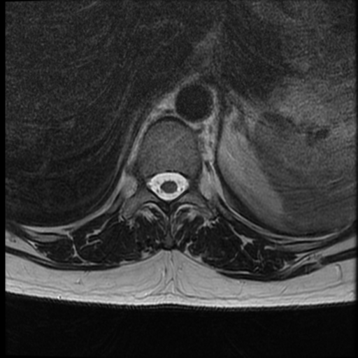 File:Normal cervical and thoracic spine MRI (Radiopaedia 35630-37156 H 12).png