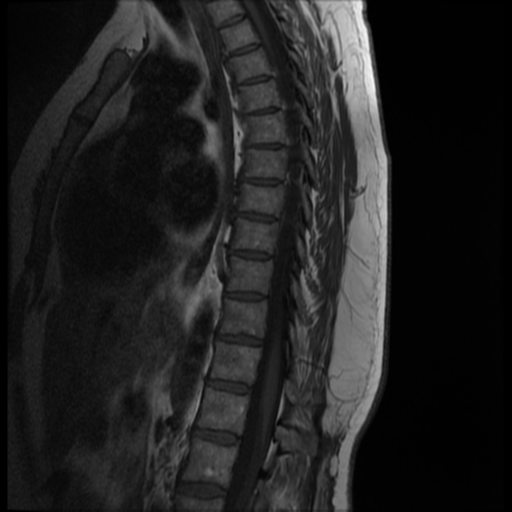 File:Normal cervical and thoracic spine MRI (Radiopaedia 35630-37156 I 6).png