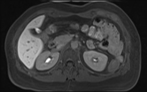File:Normal hepatobiliary phase liver MRI (Radiopaedia 58968-66230 A 53).jpg