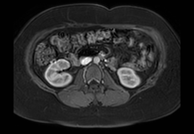 Normal liver MRI with Gadolinium (Radiopaedia 58913-66163 J 12).jpg