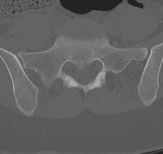 File:Normal lumbosacral CT (Radiopaedia 37923-39867 Axial bone window 82).png