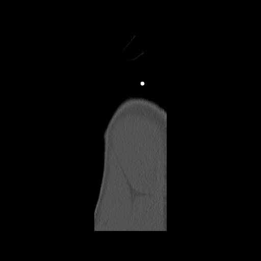 Normal pelvis (Radiopaedia 51473-57238 Sagittal bone window 2).jpg