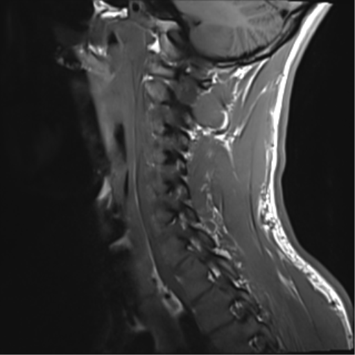 File:Normal trauma cervical spine (Radiopaedia 41017-43762 Sagittal T1 12).png