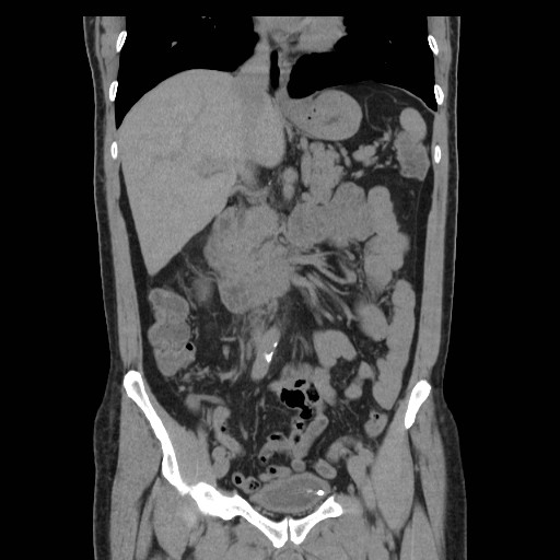 File:Obstructed kidney with perinephric urinoma (Radiopaedia 26889-27067 Coronal non-contrast 2).jpg