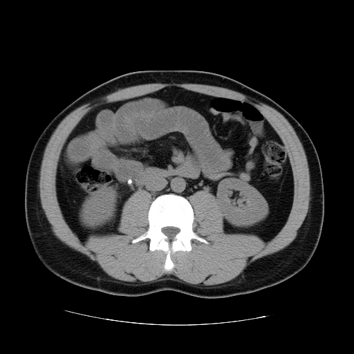 File:Obstructing ureteric calculus (Radiopaedia 18615-18514 Axial non-contrast 28).jpg