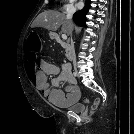 Obstructive colonic diverticular stricture (Radiopaedia 81085-94675 C 114).jpg