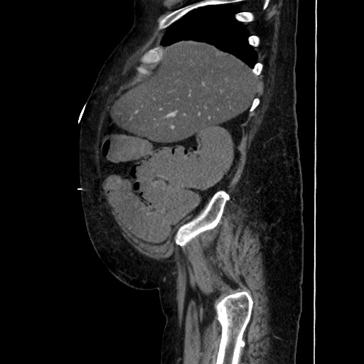 Obstructive colonic diverticular stricture (Radiopaedia 81085-94675 C 56).jpg