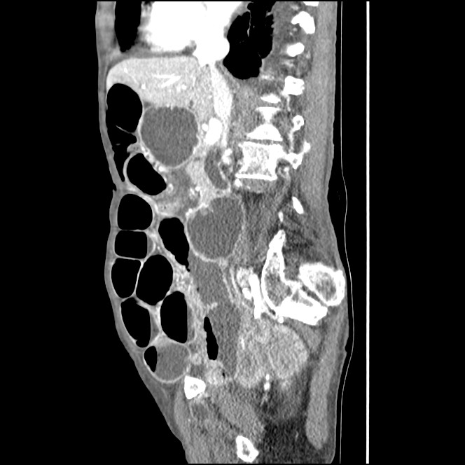 Obturator hernia causing small bowel obstruction (Radiopaedia 65522-74612 C 60).jpg