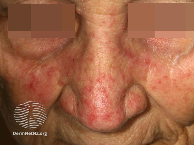 Rosacea (DermNet NZ acne-red-face-3604).jpg