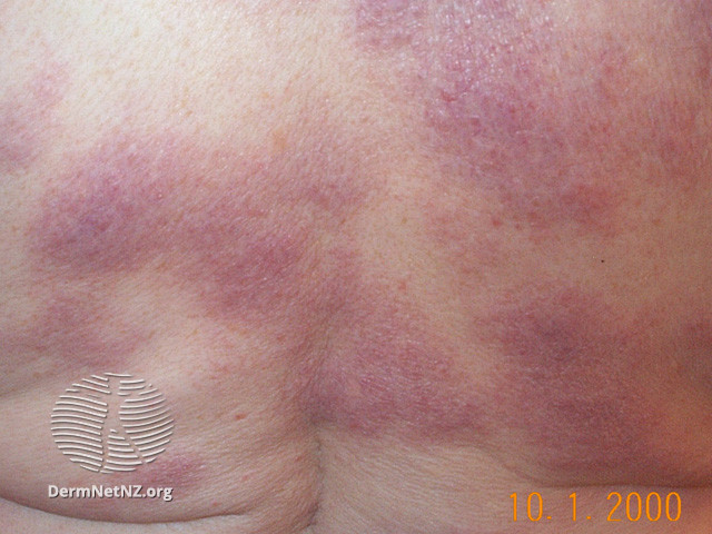 File:Sarcoid plaques (DermNet NZ dermal-infiltrative-sarcoid).jpg