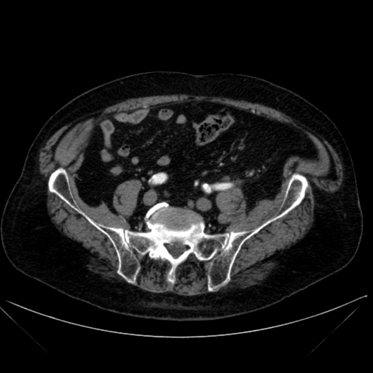 Abdominal aortic aneurysm (Radiopaedia 25855-26001 Axial C+ arterial phase 99).jpg