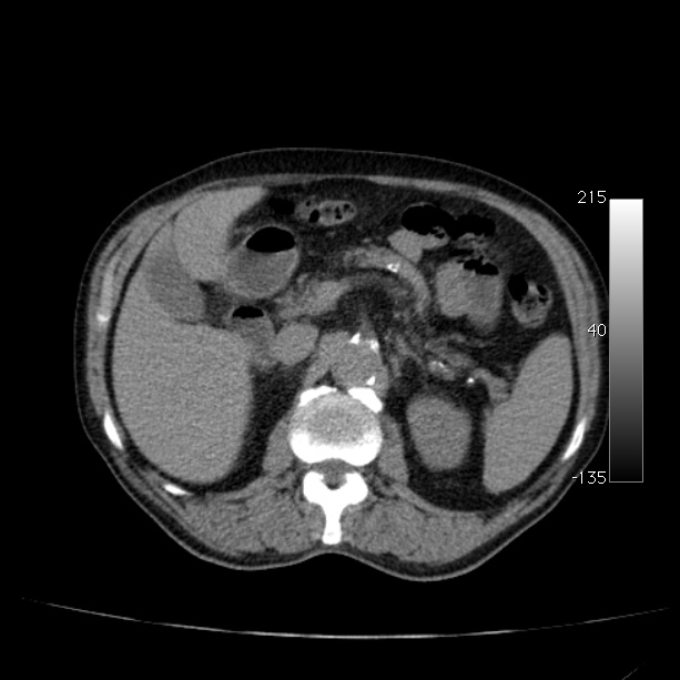 Abdominal aortic aneurysm (Radiopaedia 29248-29660 Axial non-contrast 20).jpg