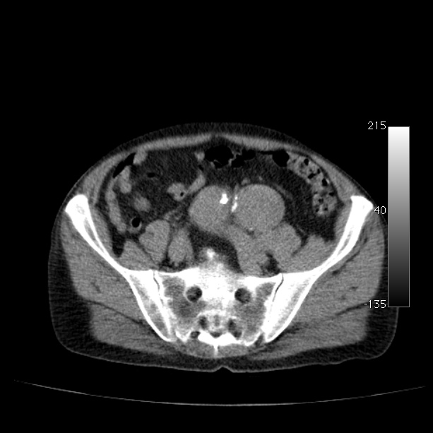 Abdominal aortic aneurysm (Radiopaedia 29248-29660 Axial non-contrast 43).jpg