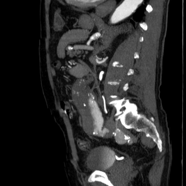 Abdominal aortic aneurysm (Radiopaedia 29248-29660 Sagittal C+ arterial phase 34).jpg