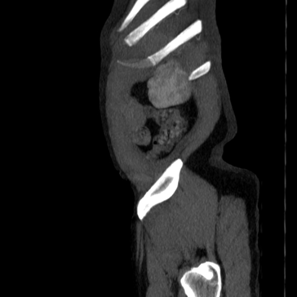 Abdominal aortic aneurysm (Radiopaedia 29248-29660 Sagittal C+ arterial phase 54).jpg