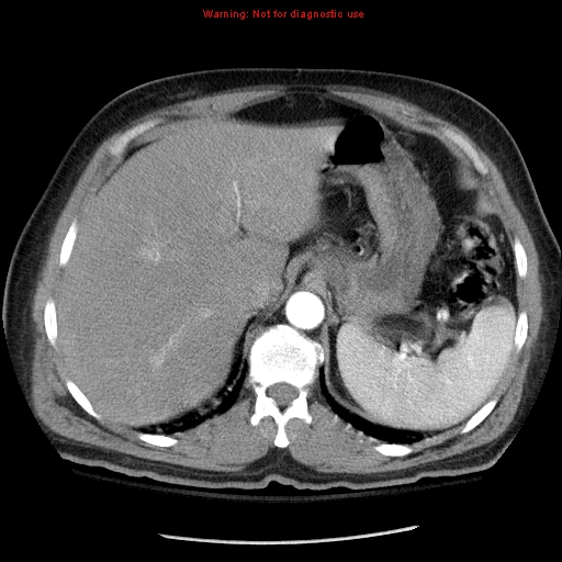 Abdominal aortic aneurysm (Radiopaedia 8190-9038 Axial C+ arterial phase 18).jpg