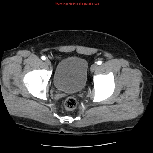 Abdominal aortic aneurysm (Radiopaedia 8190-9038 Axial C+ arterial phase 76).jpg
