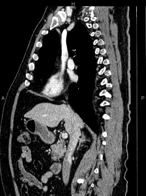 Abdominal aortic aneurysm (Radiopaedia 83094-97462 Sagittal renal cortical phase 54).jpg