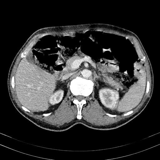 Abdominal aortic aneurysm (Radiopaedia 83581-98689 Axial C+ portal venous phase 38).jpg