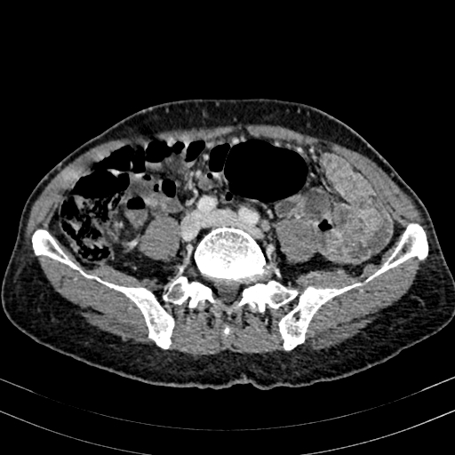 Abdominal aortic aneurysm (Radiopaedia 83581-98689 Axial C+ portal venous phase 75).jpg