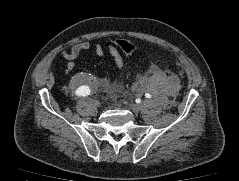 Abdominal aortic aneurysm rupture (Radiopaedia 54179-60362 Axial C+ portal venous phase 9).jpg