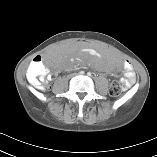 Abdominal desmoid tumor (Radiopaedia 41007-43740 Axial C+ portal venous phase 42).png