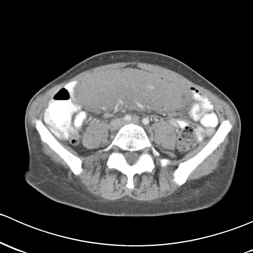 Abdominal desmoid tumor (Radiopaedia 41007-43740 Axial C+ portal venous phase 44).png