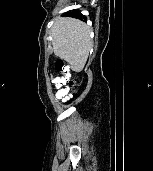 Abdominal lymphoma with sandwich sign (Radiopaedia 84378-99704 Sagittal C+ portal venous phase 3).jpg
