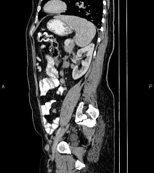 File:Abdominal lymphoma with sandwich sign (Radiopaedia 84378-99704 Sagittal C+ portal venous phase 65).jpg