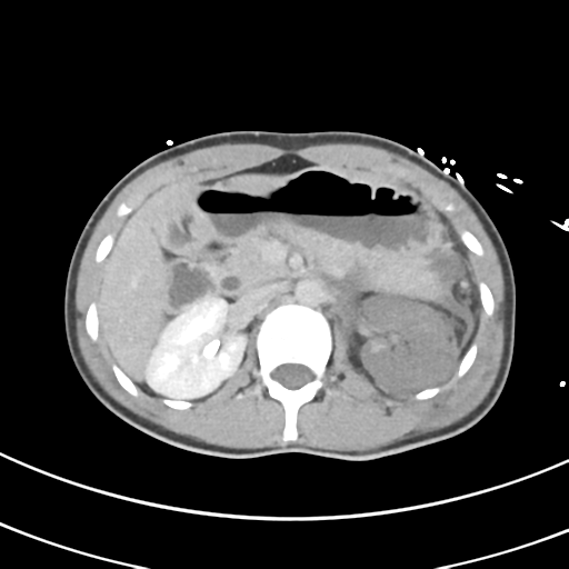 File:Abdominal multi-trauma - devascularised kidney and liver, spleen and pancreatic lacerations (Radiopaedia 34984-36486 Axial C+ delayed 27).png