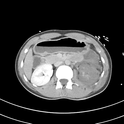 File:Abdominal multi-trauma - devascularised kidney and liver, spleen and pancreatic lacerations (Radiopaedia 34984-36486 Axial C+ delayed 30).png