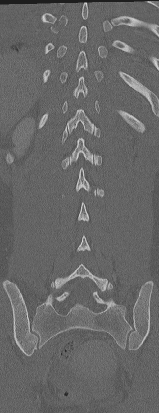 Abdominal multi-trauma - devascularised kidney and liver, spleen and pancreatic lacerations (Radiopaedia 34984-36486 Coronal bone window 52).png