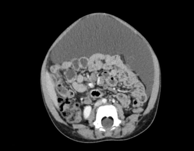 Abdominal premesenteric cystic lymphangioma (Radiopaedia 82995-97350 Axial C+ portal venous phase 35).jpg