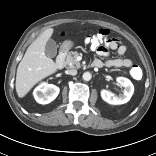 Abdominal wall metastasis from colorectal carcinoma (Radiopaedia 31016-31717 Axial C+ portal venous phase 28).jpg