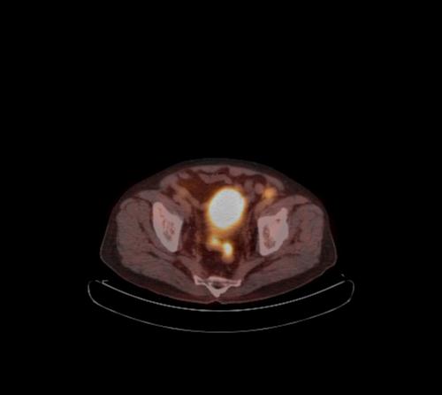 File:Abdominal wall metastasis from colorectal carcinoma (Radiopaedia 31016-31719 C 32).jpg