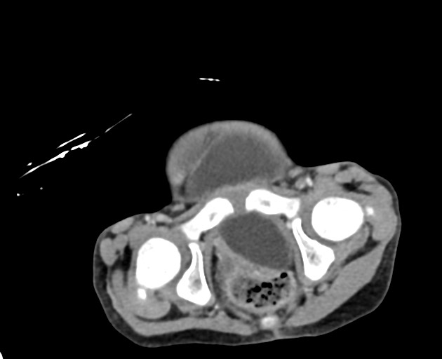 Abdominopelvic rhabdomyosarcoma (Radiopaedia 78356-90984 Axial C+ portal venous phase 150).jpg
