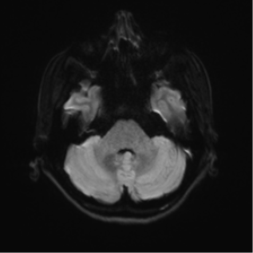 File:Abducens nerve palsy (Radiopaedia 51069-56648 Axial DWI 33).png