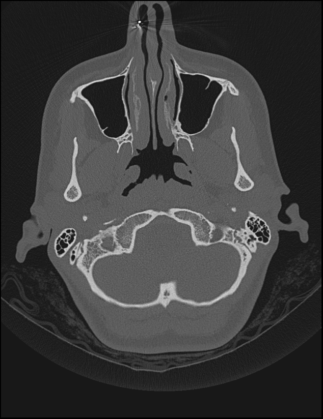 Aberrant right internal carotid artery (Radiopaedia 65191-74198 Axial non-contrast 14).jpg