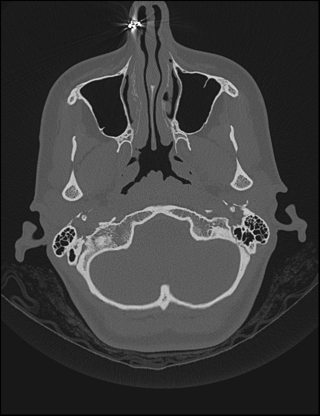 Aberrant right internal carotid artery (Radiopaedia 65191-74198 Axial non-contrast 16).jpg