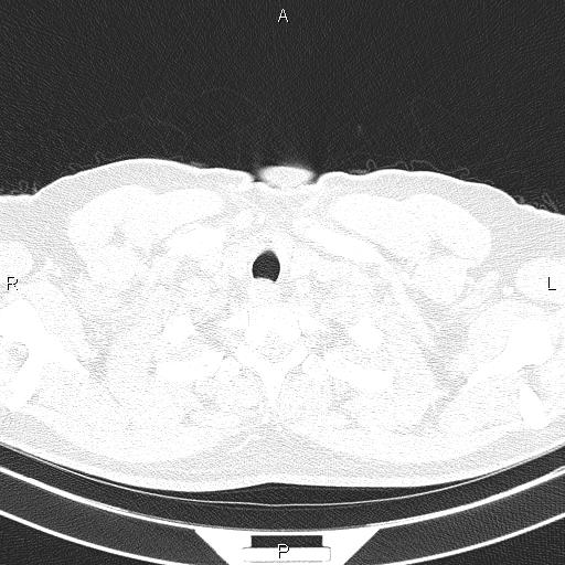 File:Aberrant right subclavian artery (Radiopaedia 87093-103354 Axial lung window 6).jpg