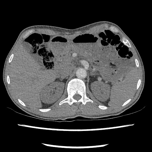 Accessory left horizontal fissure with lingular pneumonia (Radiopaedia 53763-59843 Axial C+ CTPA 94).jpg