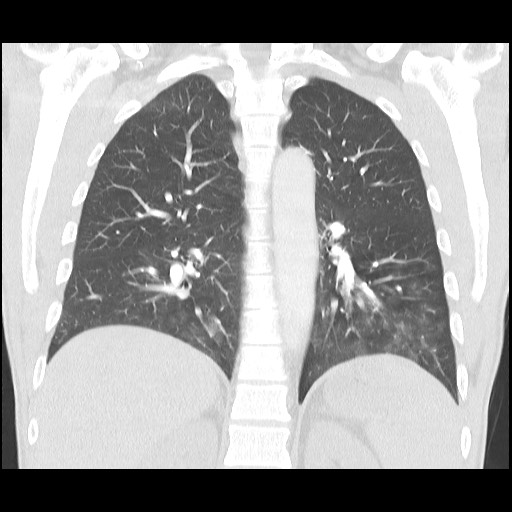 Accessory left horizontal fissure with lingular pneumonia (Radiopaedia 53763-59843 Coronal lung window 30).jpg