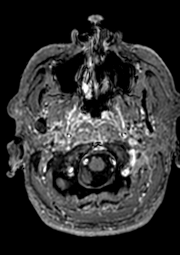 Accessory middle cerebral artery (Radiopaedia 73114-83828 Axial T1 C+ 186).jpg