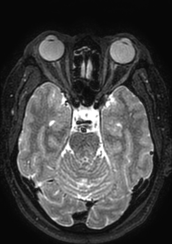 Accessory middle cerebral artery (Radiopaedia 73114-83828 Axial T2 131).jpg