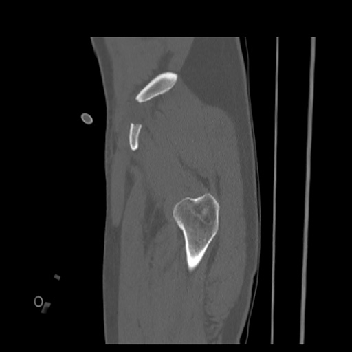 Acetabular and ilial fractures (Radiopaedia 59084-66378 Sagittal bone window 10).jpg